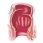 fistulas anales (1)