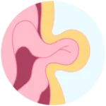 hernias web