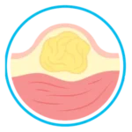 lipomas
