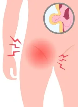 Cirujano Especialista en Hernia Inguinal en Oaxaca