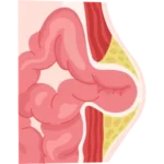 Cirugía de Hernia en Ciudad Juárez
