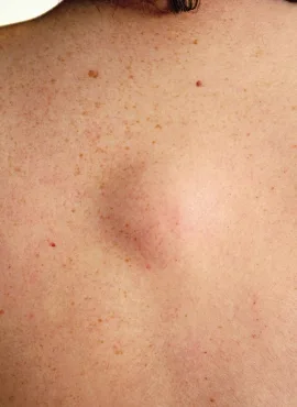extraer lipoma Especialista en Lipomas en Oaxaca