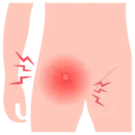 Cirugía de Hernia en Ciudad Juárez