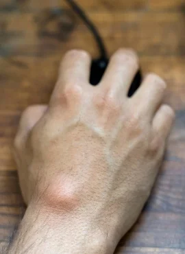 lipoma Especialista en Lipomas en Oaxaca