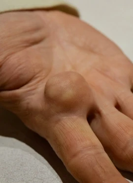 quitar lipoma Especialista en Lipomas en Oaxaca